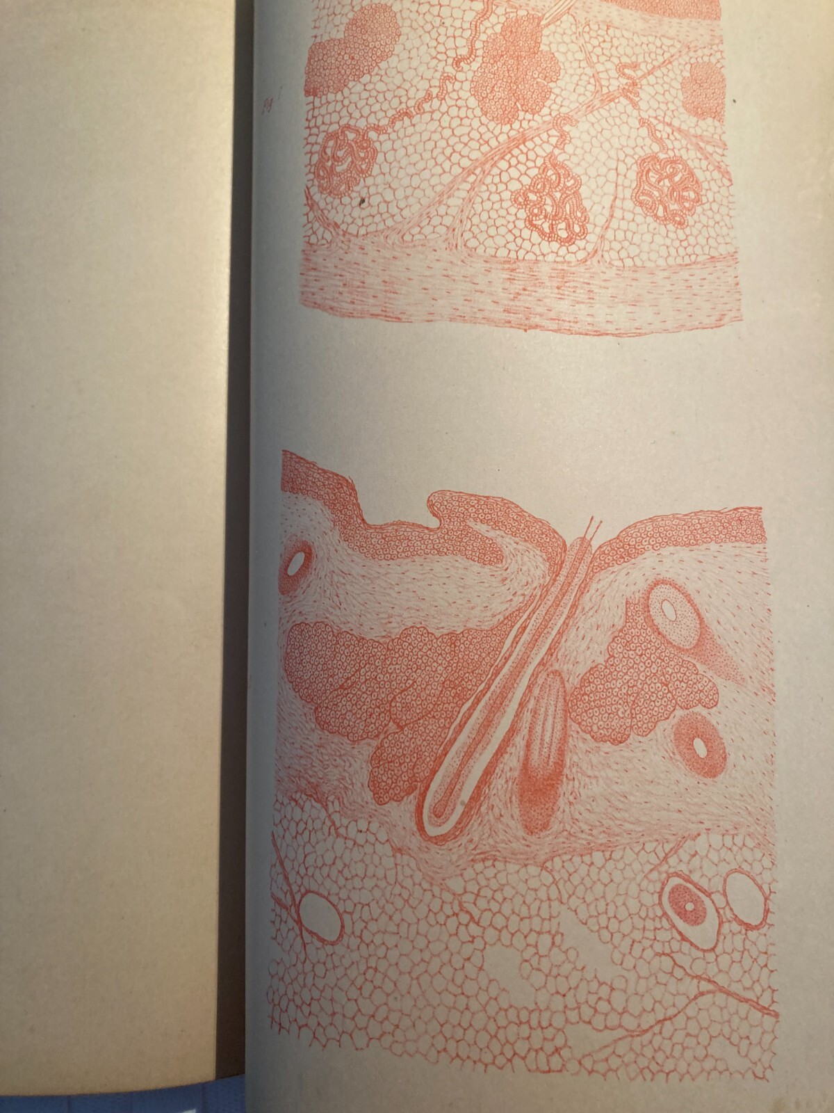 Medicina, Ginecologia, Neoplasia Dermoide: Piantieri, Gallozzi, Amati Inc.   Napoli