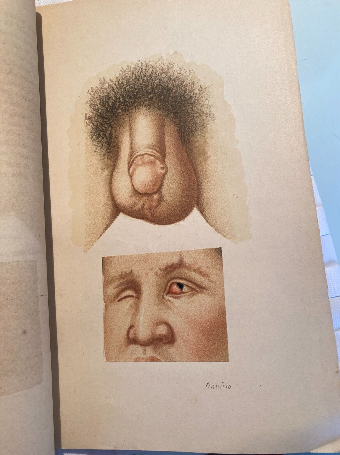 Medicina Oculistica: Lebbra   De Vincentiis   Raitano   Napoli   Palermo