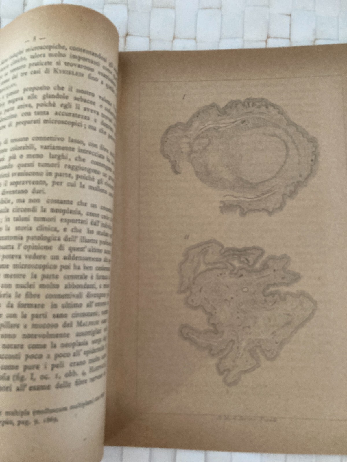 Roberto Cimmino, Sarcoma E Fibroma Multiplo, 1891