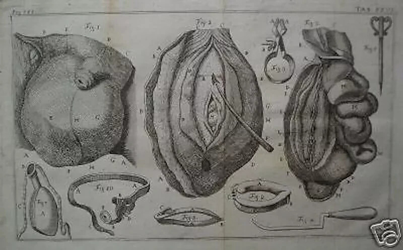 Medicina, Chirurgia, Urologia, Varicocele, Ernia: Antica Incisione Da Collezione Del XVIII Secolo