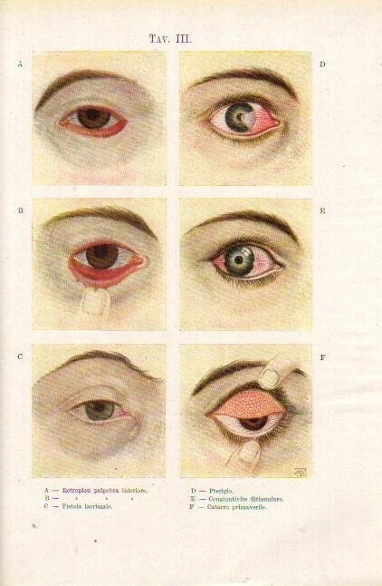 Trattato Pratico Di Oculistica Siro Francesco Piccaluga 1934