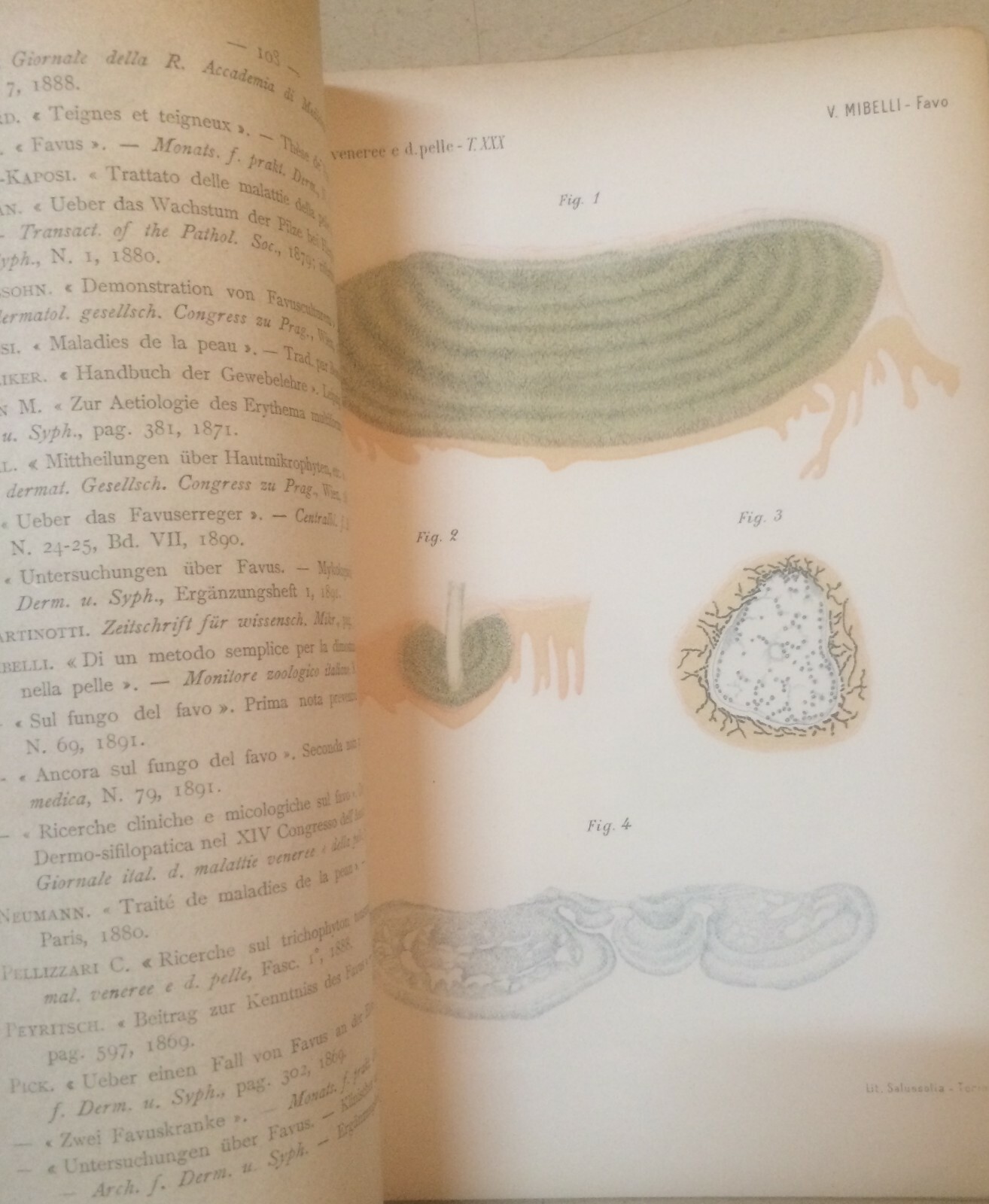 Medicina: Dermatologia, Favo E Tigna In Sardegna. Mibelli, 1892