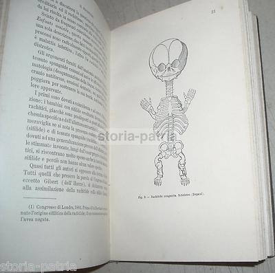 Il Rachitismo: Medicina, Ortopedia E Pediatria (1894)