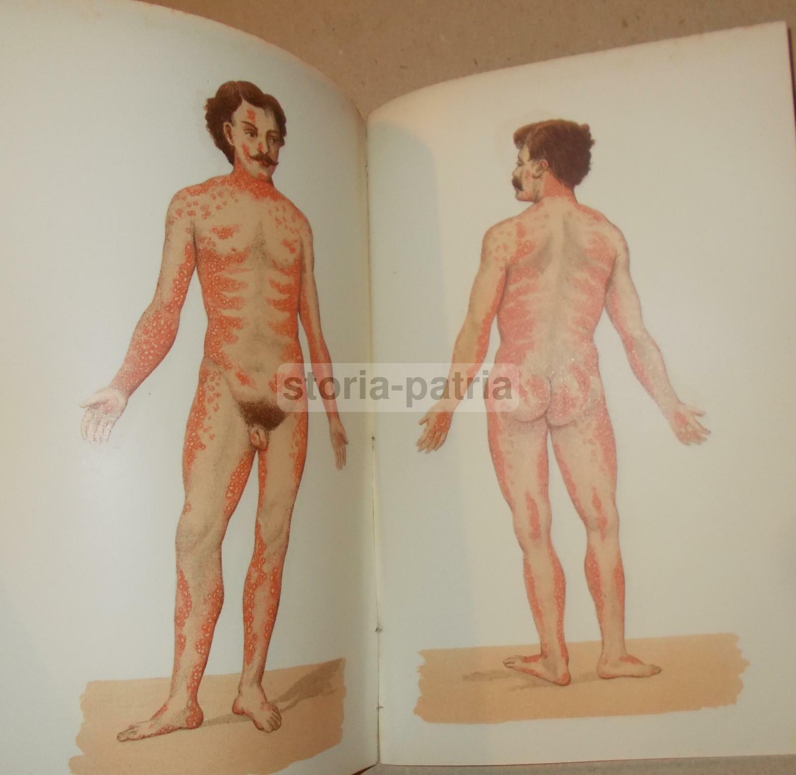Medicina, Dermatologia: Herpes Zoster, Colombini, Con Due Tavole A Colori, Siena, 1893
