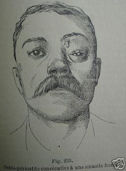 Medicina Oculistica: Précis d'Ophtalmologie Di Felix Lagrange, 1921