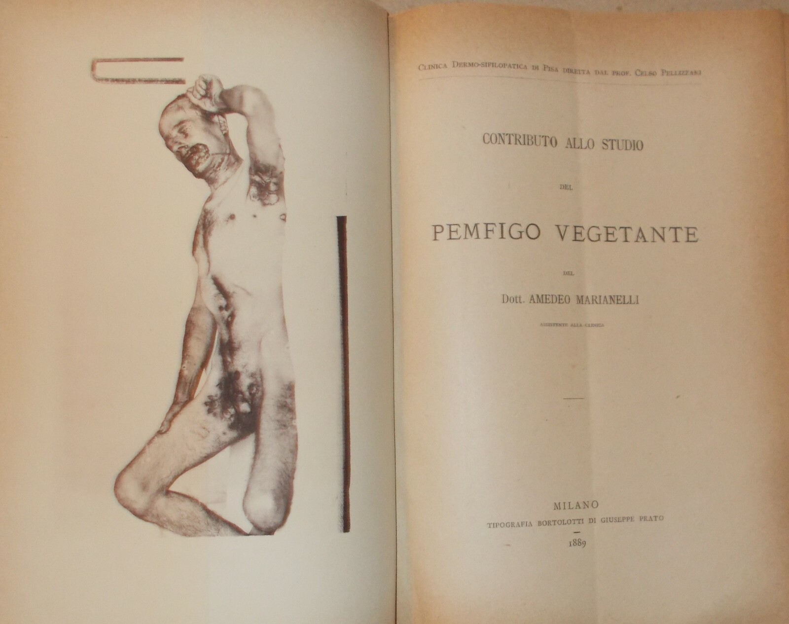 Medicina: Pemfigo Vegetante, Dr. Marianelli, Pisa, Clinica Dermo Sifilopatica, 1889