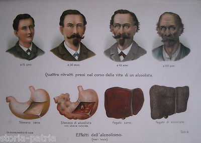 Medicina: Alcolismo, L'Alcolista Nelle Sue Varie Età (stomaco, Fegato), Patologie. Litografia.