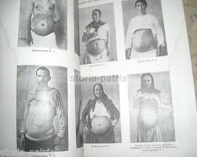 A. Nannotti: Secondo Contributo Allo Studio Delle Indicazioni Sulla Splenectomia Nella Splenomegalia Malarica