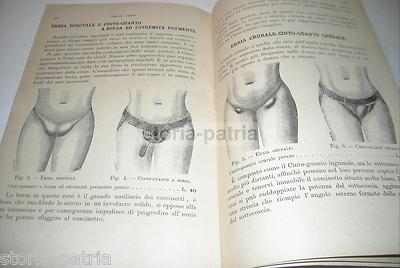 Medicina, Chirurgia, Sanitaria: Ernie Inguinali, Ventriere, Cinti Erniari   Pubblicità