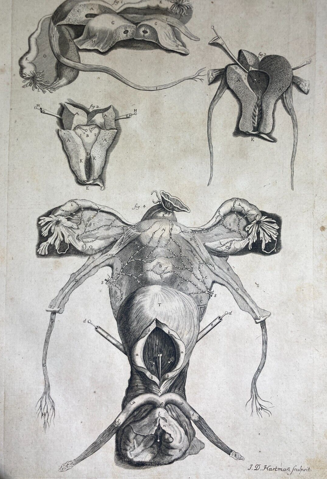 Medicina: Anatomia Umana, Ginecologia, Utero E Ovaie. Incisione Di Hartman, XVIII Secolo