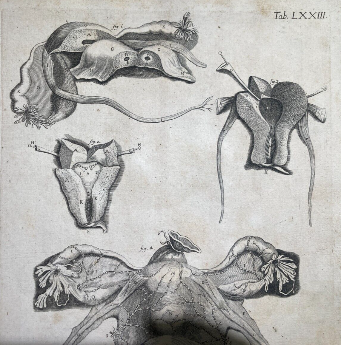 Medicina: Anatomia Umana, Ginecologia, Utero E Ovaie. Incisione Di Hartman, XVIII Secolo