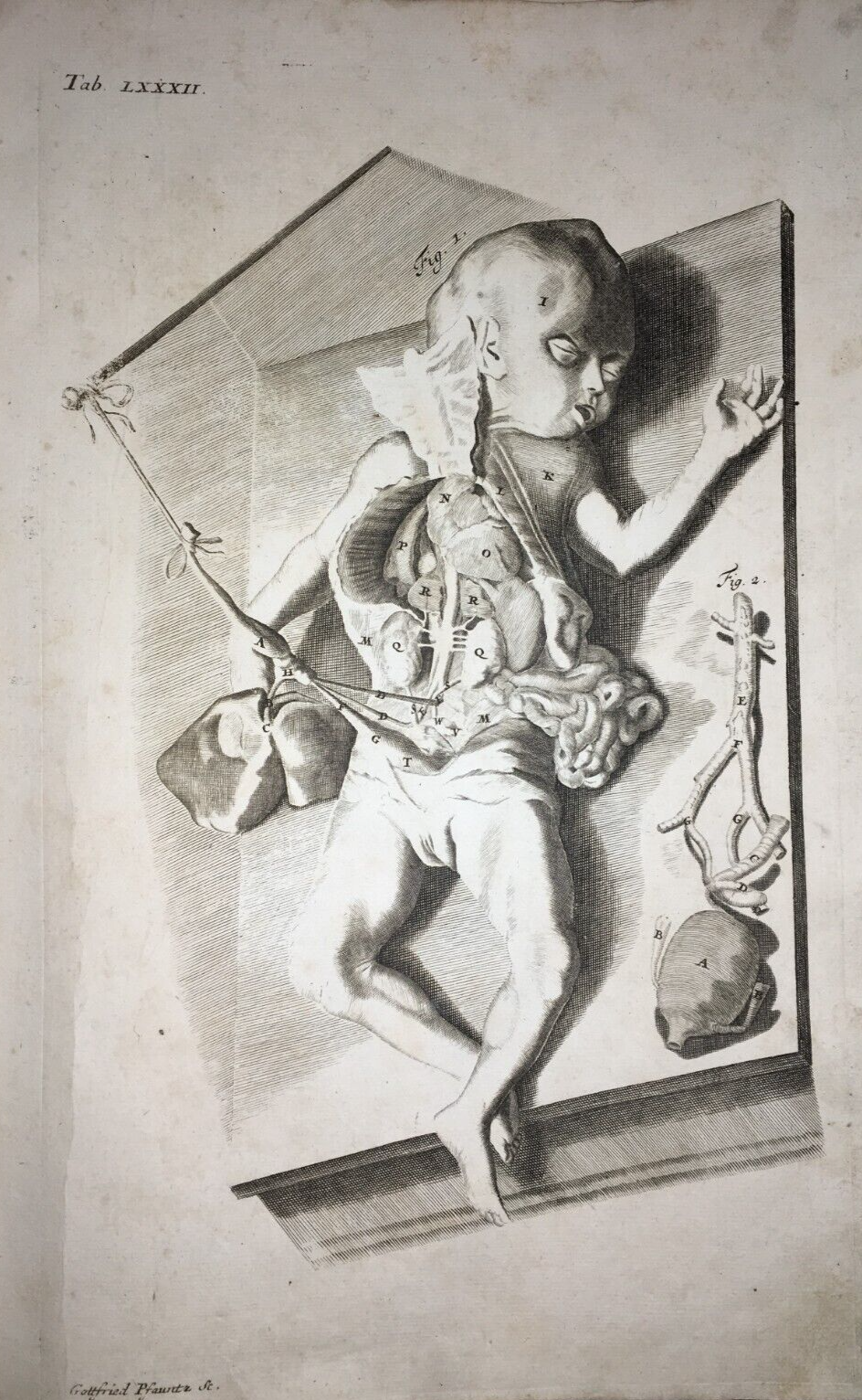 Medicina, Pediatria, Apparato Intestinale, Addome Aperto: Antica Rara Incisione Del '700
