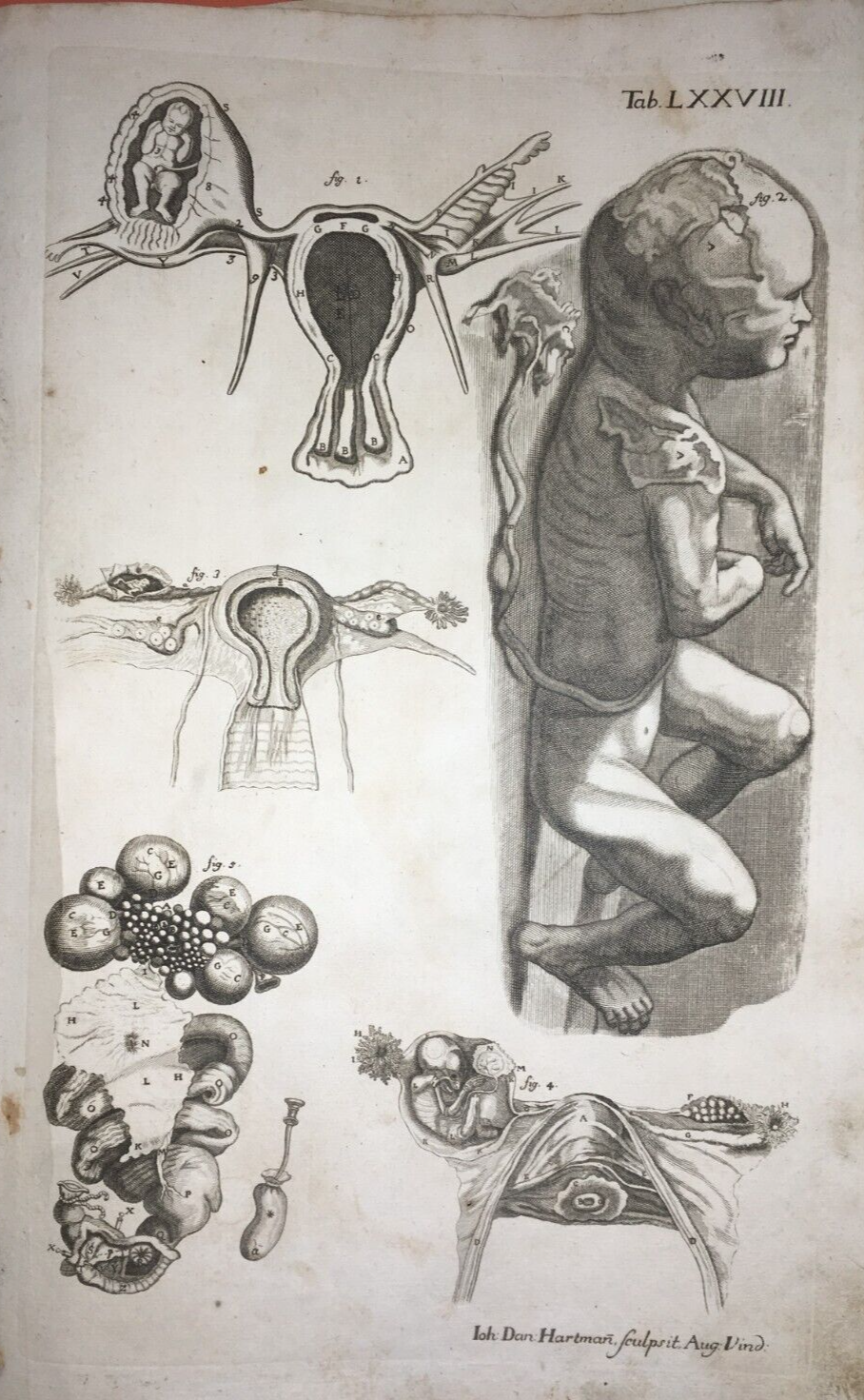 Medicina, Pediatria, Ostetricia, Ginecologia: Incisione Antica Di Feto, Hartmann, XVIII Secolo.