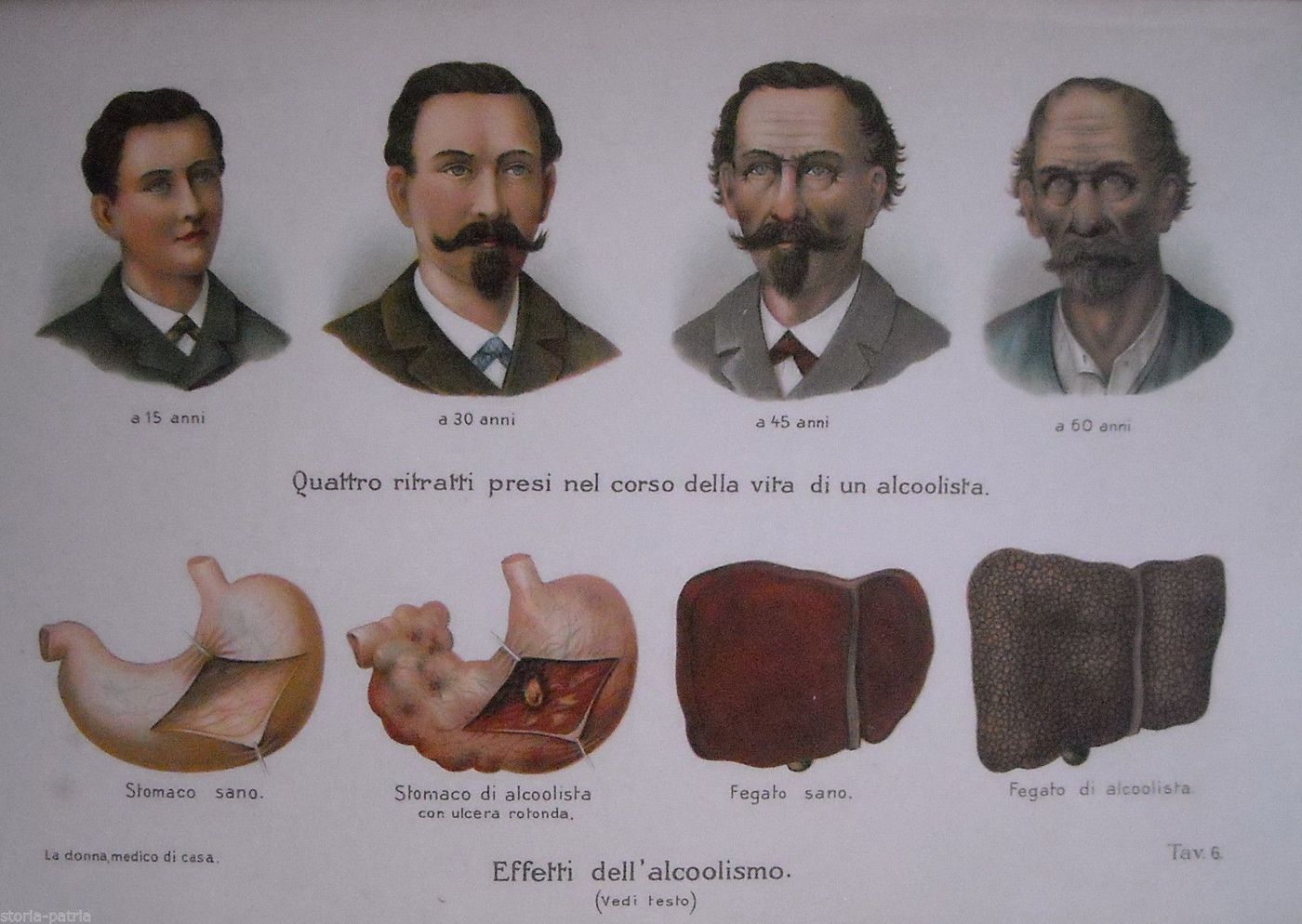 Stampa Antica Alcolismo: Effetti Fisionomici E Organi, 1920, Litografia