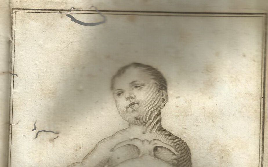 Bambino Mostruoso Nola 1805 De Luca Anatomia Patologia Rara
