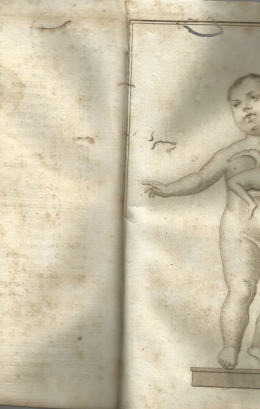Bambino Mostruoso Nola 1805 De Luca Anatomia Patologia Rara