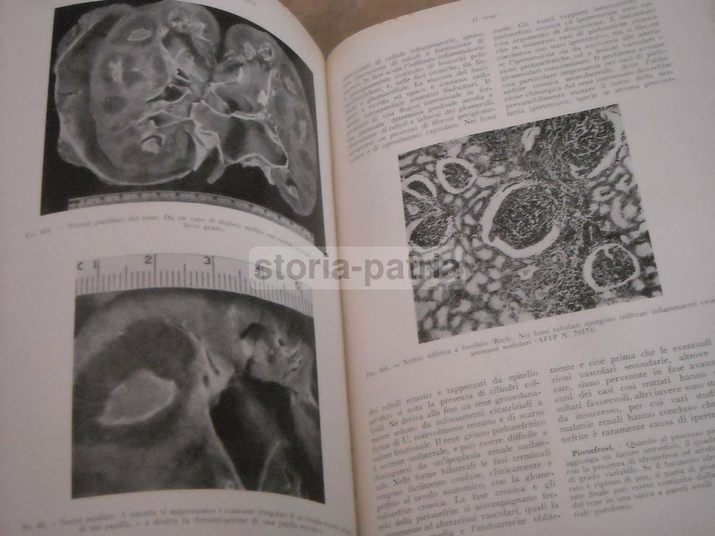 Trattato Di Anatomia Patologica Anderson 3 Volumi SEU 1956