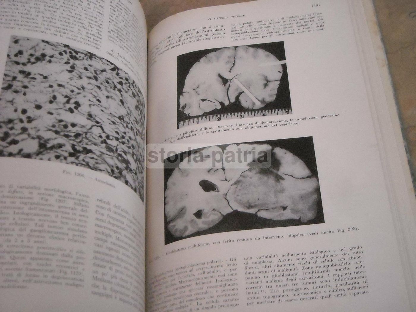 Trattato Di Anatomia Patologica Anderson 3 Volumi SEU 1956