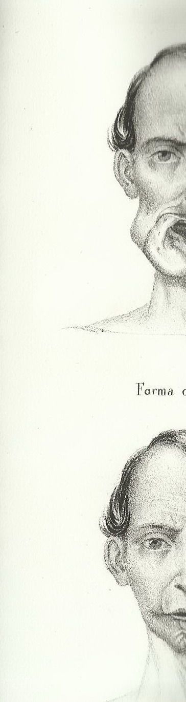Memoria Chirurgica Sulla Resezione Della Mascella Inferiore, Francesco Cianflone, Napoli, 1850