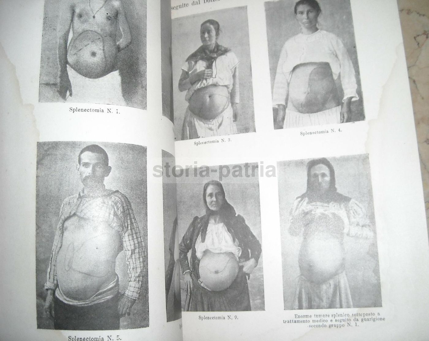 Nannotti, Studio Sulla Splenectomia Nella Splenomegalia Malarica (1900)