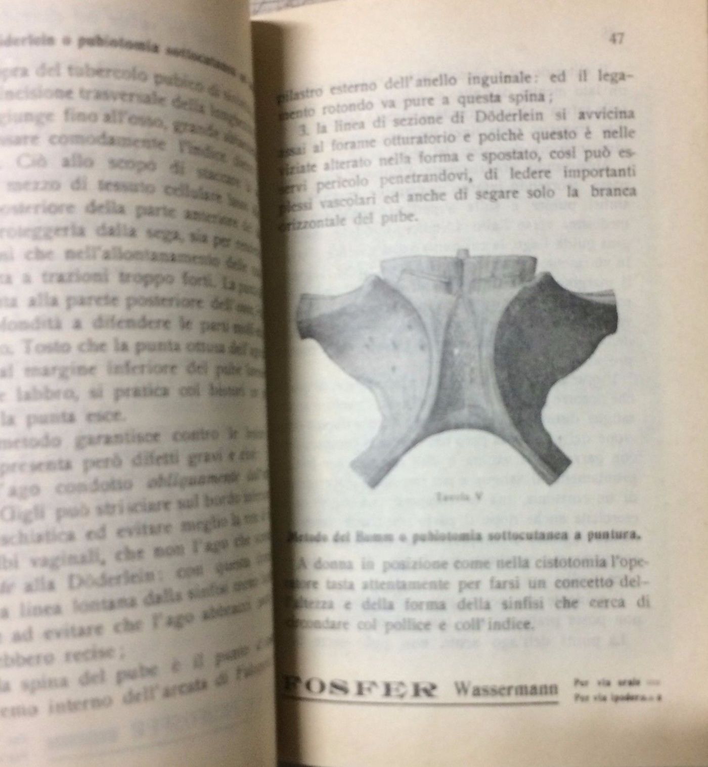I Vizii Pelvici: Parte II Operazioni   Francesco Giulio Villa (1913)