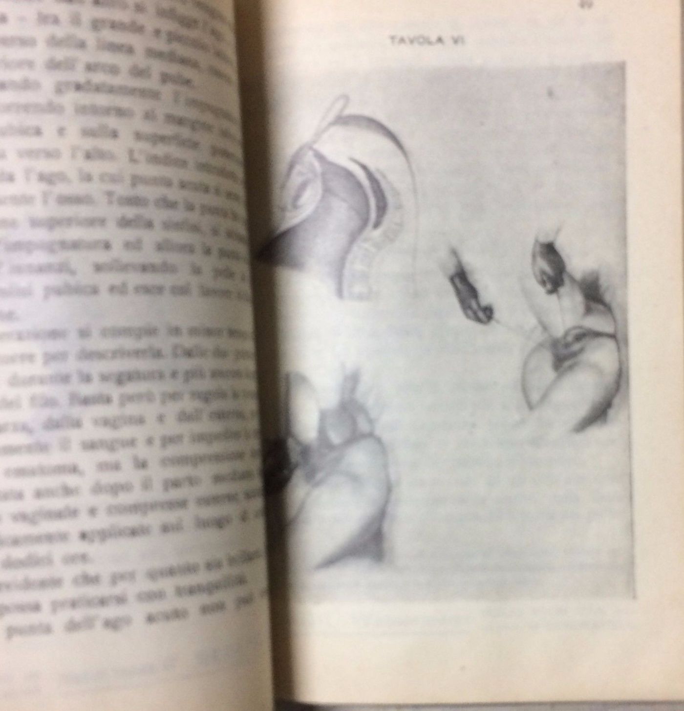I Vizii Pelvici: Parte II Operazioni   Francesco Giulio Villa (1913)
