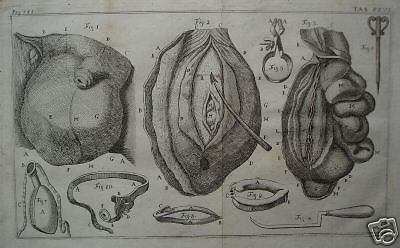 Incisione Antica Di Chirurgia Urologica: Varicocele Ed Ernia (1750)