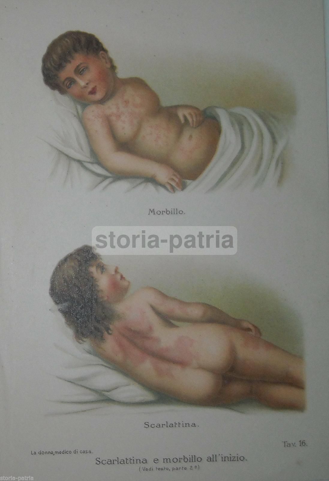 Stampa Antica Scarlattina E Morbillo Cromolitografia 1920 Medicina