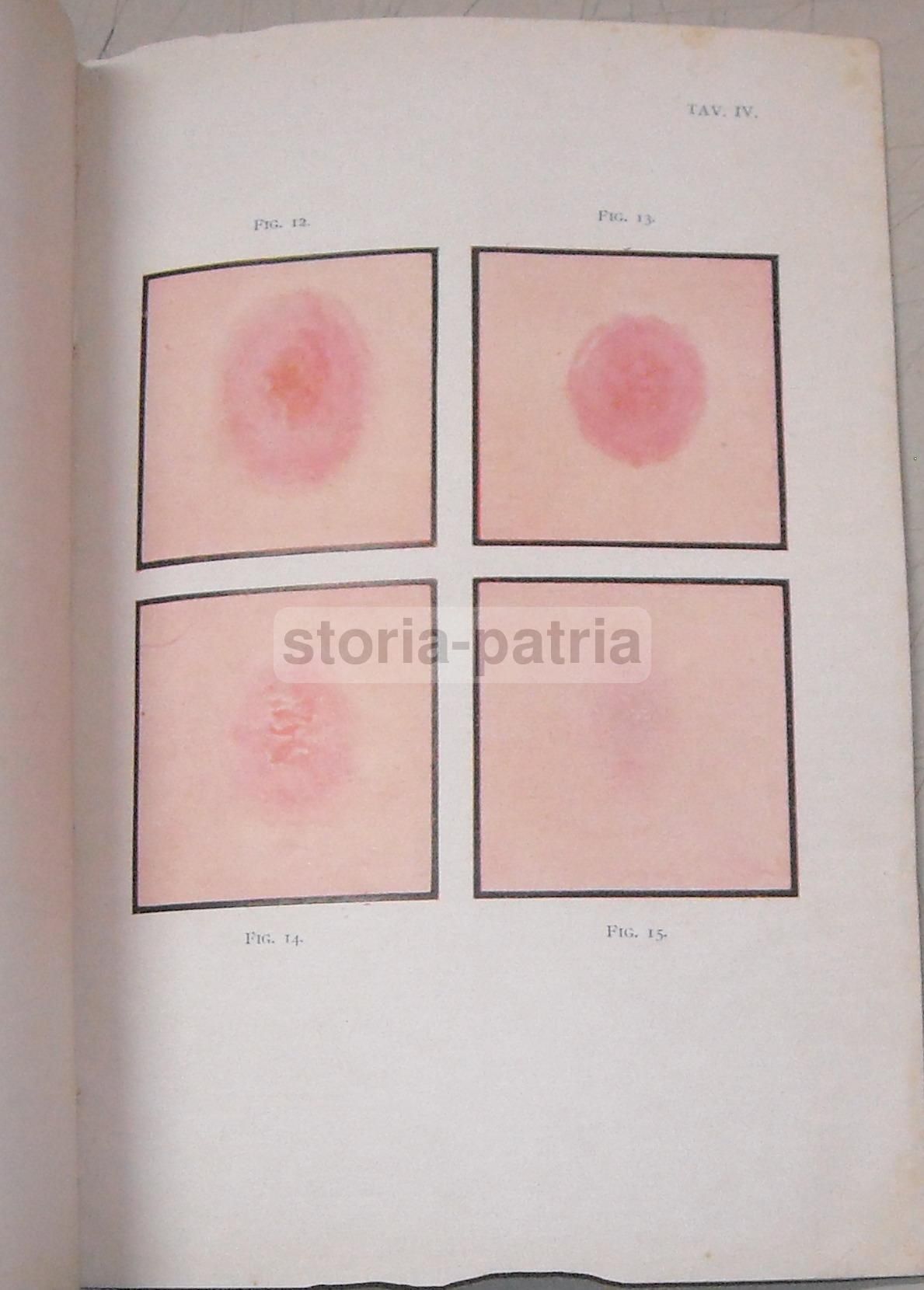 Difterite: Note Epidemiologiche E Profilattiche, 1930