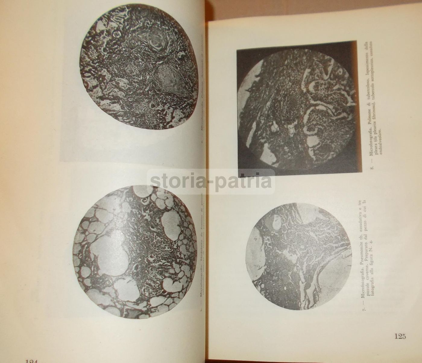 La Tisiologia Nella Pratica Medica. Wassermann, 1933