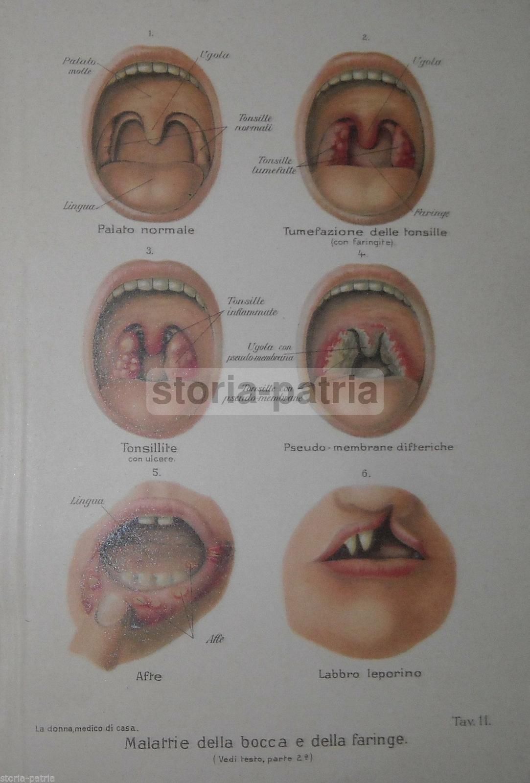 Cromolitografia Medica: Malattie Della Bocca, Della Faringe E Tonsillite (1920)