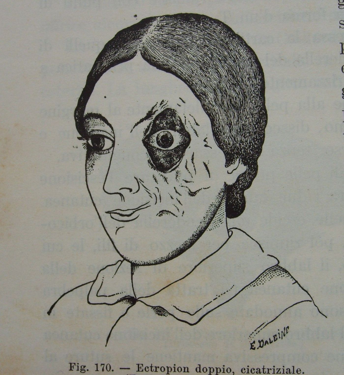 Trattato Di Chirurgia: L'Occhio Ed I Suoi Annessi, 1898