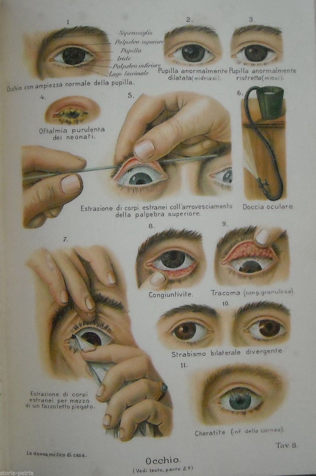 Stampa Antica Oftalmologia Malattie Oculari Cromolitografia 1920