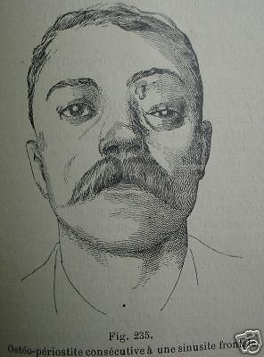 Précis d'Ophtalmologie Lagrange 1921 Illustrato Oftalmologia