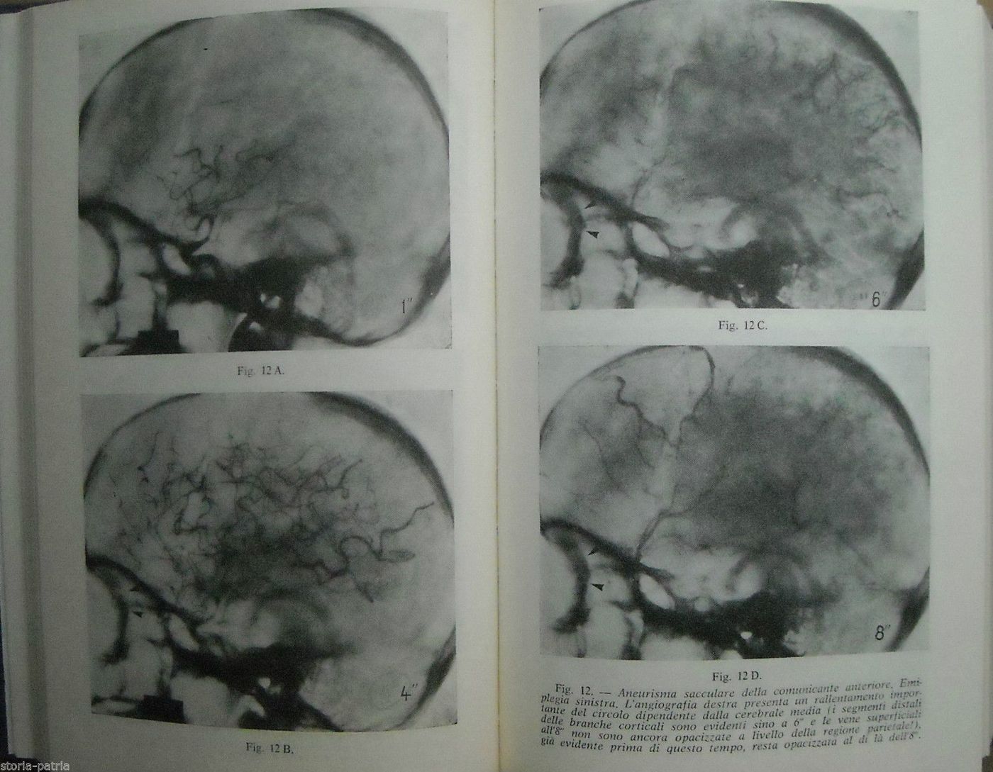 Oftalmodinamometria E Affezioni Cerebrovascolari, 1965