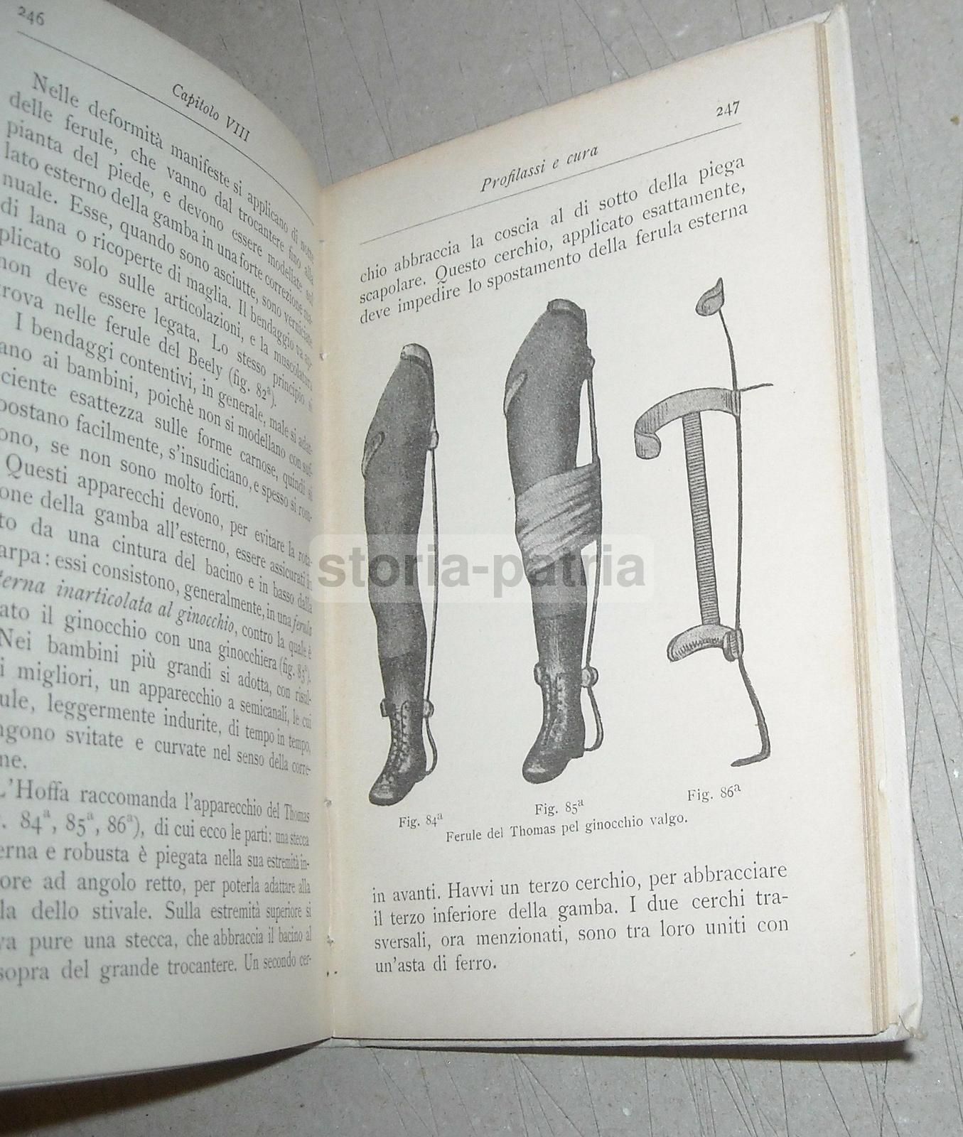 La Rachidite Di Paolo Mancini (Hoepli 1904). Ortopedia E Deformità