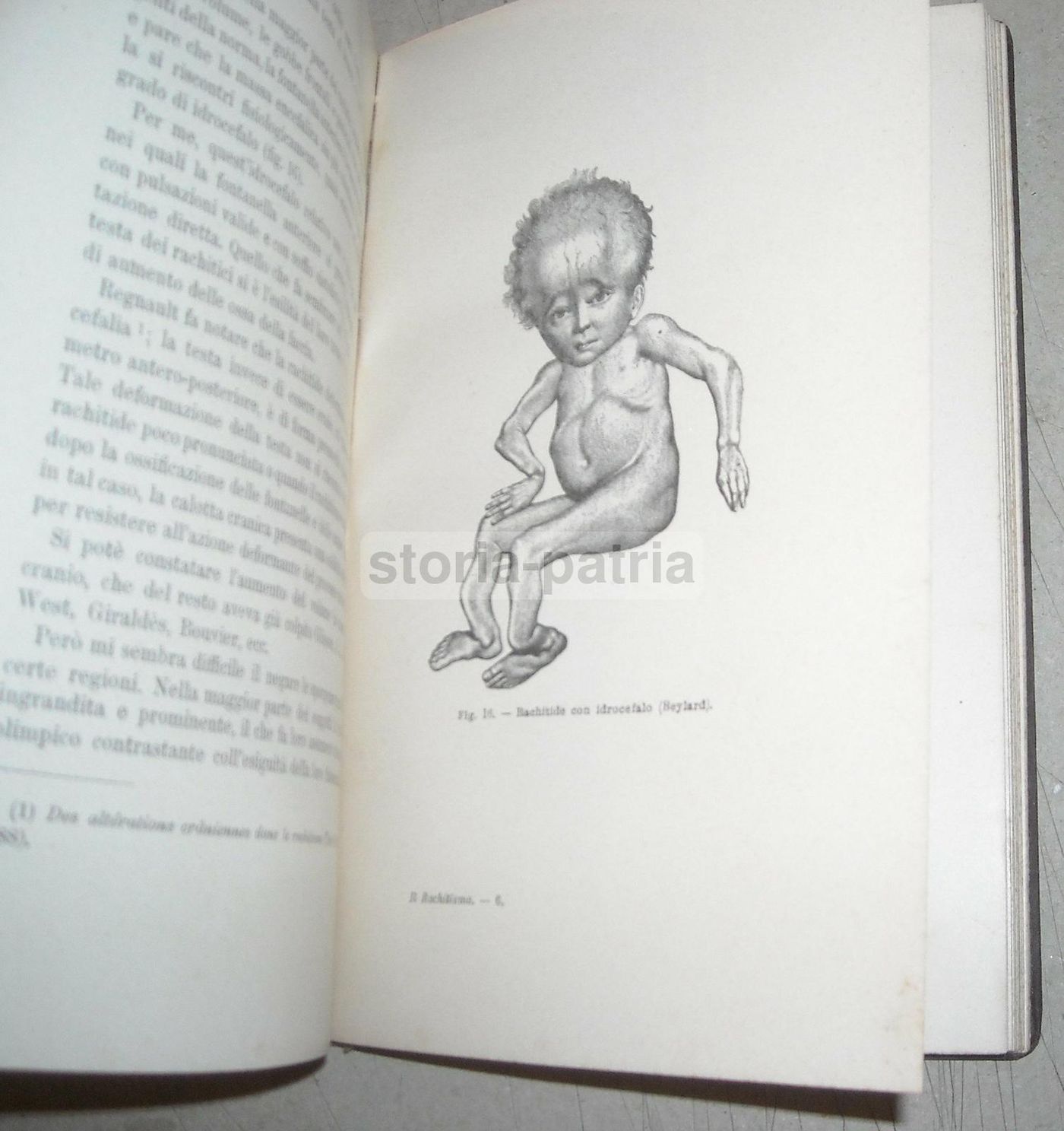 Il Rachitismo Di J. Comby 1894: Medicina E Ortopedia, UTET Torino