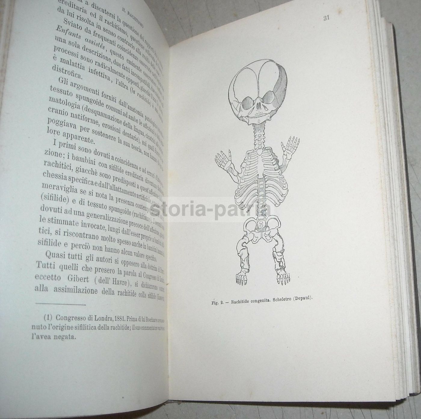 Il Rachitismo Di J. Comby 1894: Medicina E Ortopedia, UTET Torino