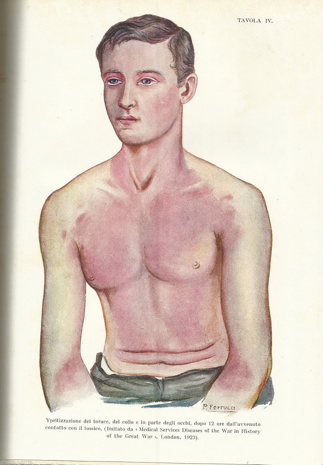 Fisiopatologia E Clinica Dei Gas Da Combattimento   Alessandro Lustig (1931)