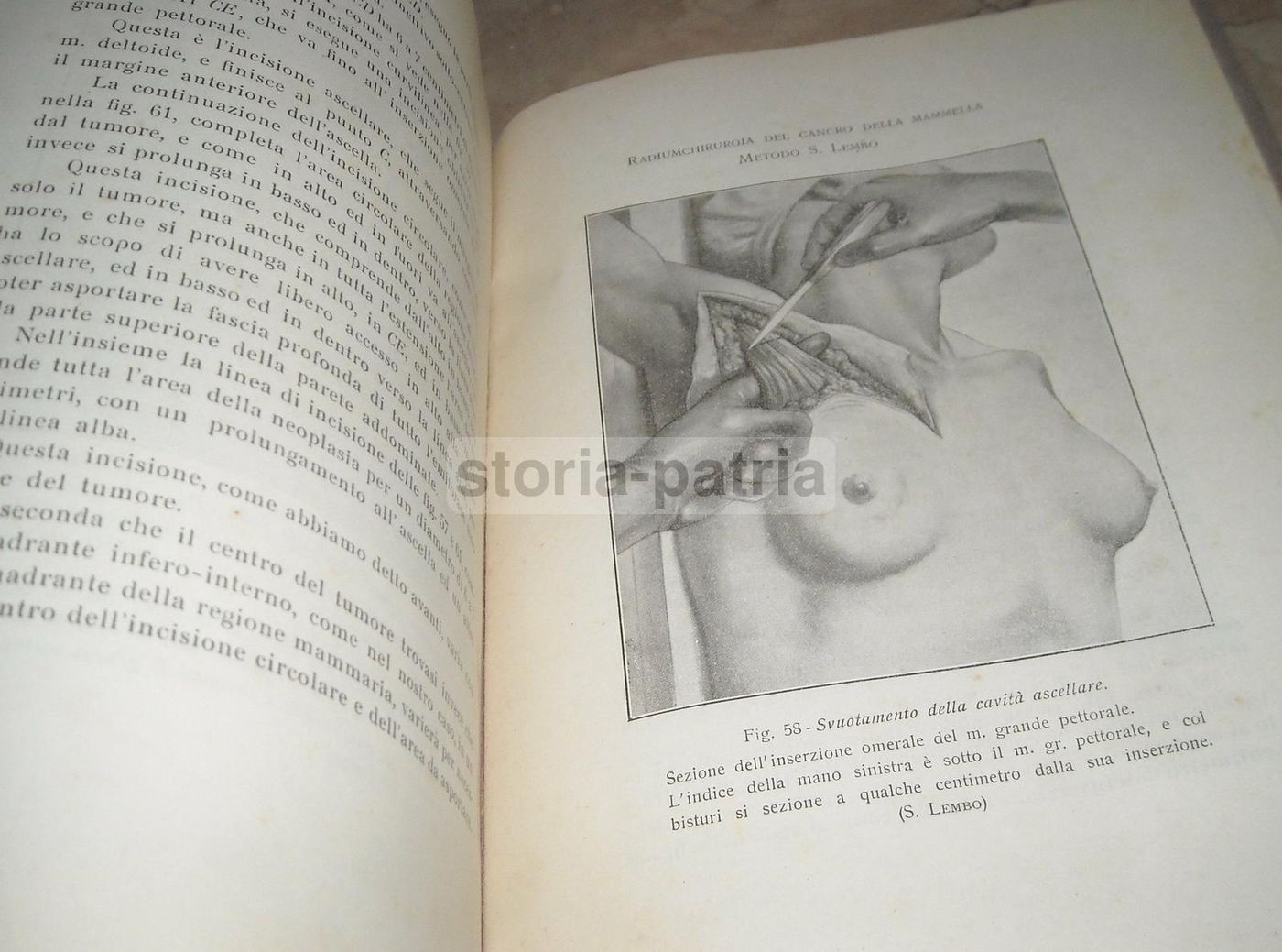 Sabino Lembo: La Radiumchirurgia Del Cancro Della Mammella (1927)