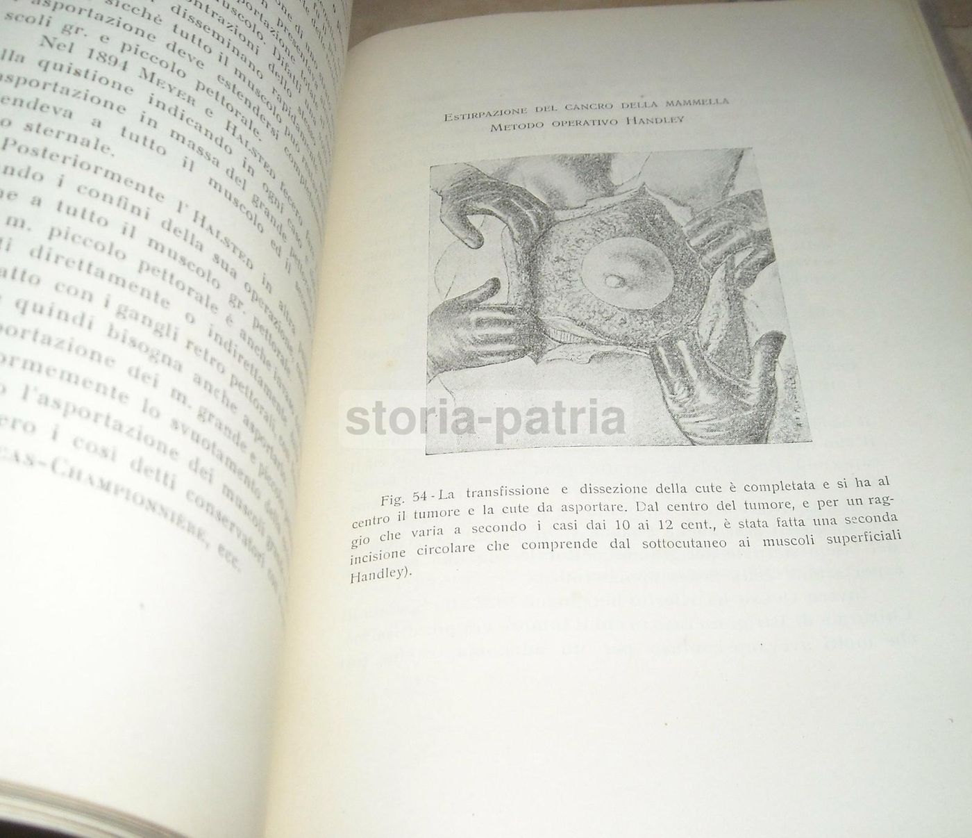 Sabino Lembo: La Radiumchirurgia Del Cancro Della Mammella (1927)